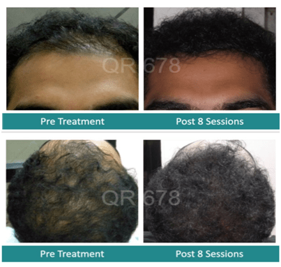 Best hair treatment in Mumbai, India for hair loss, fall in men and women by QR678, The Esthetic Clinics