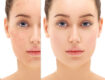 treatments for facial pigmentation