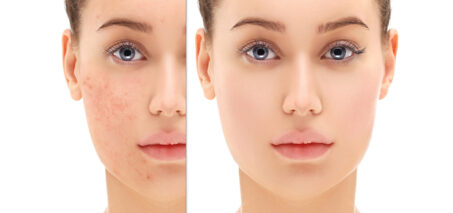 treatments for facial pigmentation